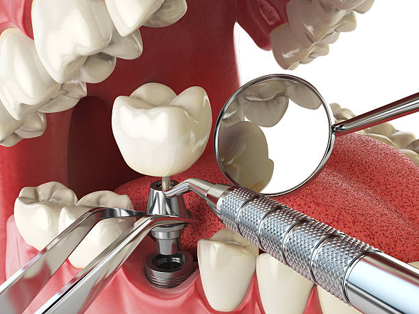 Best Emergency Dentist for Lost Fillings or Crowns in Twin Lakes, CO
